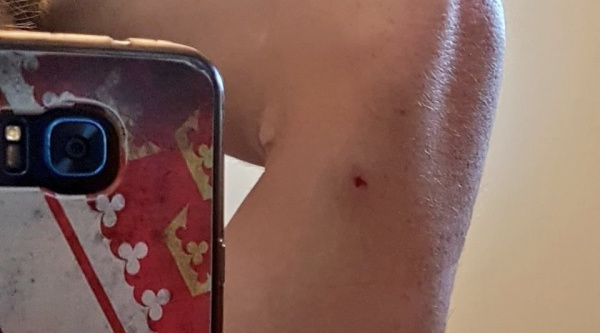 Una de las heridas de Maxime Marotte